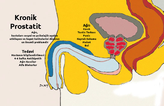 Kronik Prostatit Bitkisel Tedavi