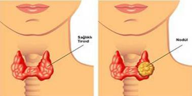 Tiroid Nodl Bitkisel Tedavi