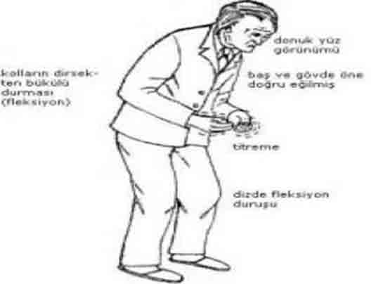 Parkinson Hastal Bitkisel Tedavi