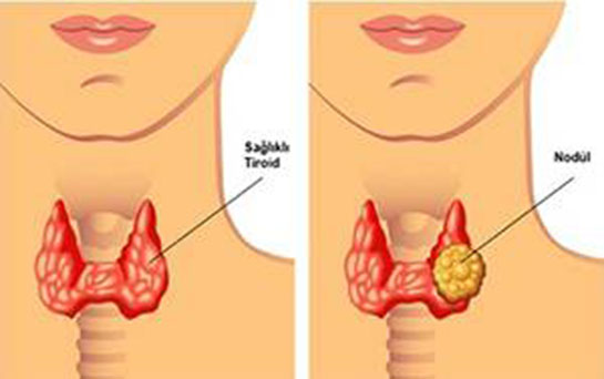 Tiroid Nodl Bitkisel Tedavi