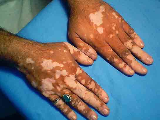 Vitiligo Bitkisel Tedavi